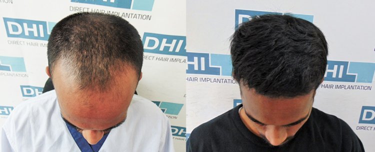 Exclusive Technique Now Available Only in DHI's Authorized Clinics